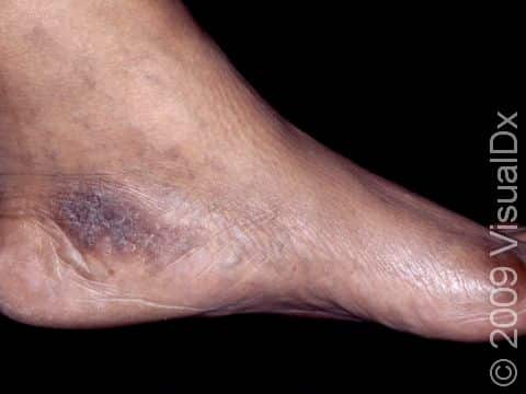 This child has been rubbing or scratching the area between the heel and the ankle, leading to dark, rough areas of thickened skin known as lichen simplex chronicus.