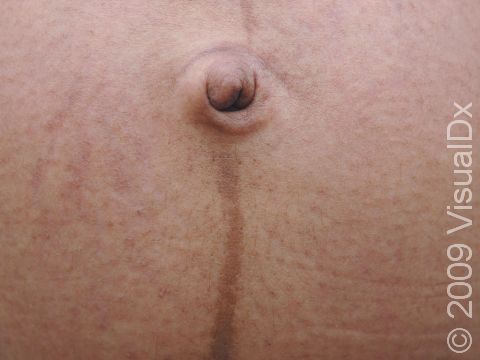 The dark brown line of linea nigra typically extends above and below the belly button.