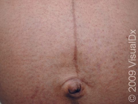 Linea nigra is typically seen in pregnant women as a sharp vertical, flat, dark line in the middle of the stomach.