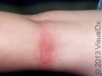 Lyme Disease