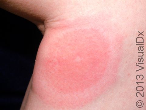 This is a classic presentation of Lyme disease, with a pink circle appearing to spread outward from the tick bite.