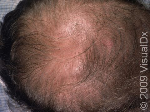 This image displays typical male-pattern balding with thinning at the top of the scalp.