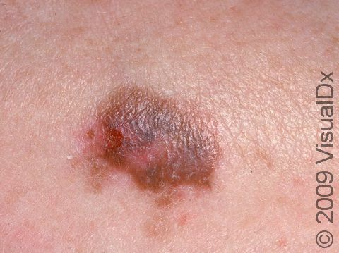 This image displays a brown, blue-gray, and pink lesion with an irregular border typical of early melanoma.