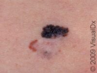 Melanoma