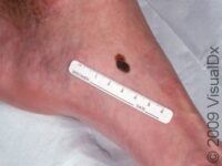 Melanoma