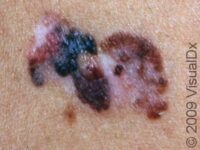 Melanoma