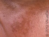 Melasma