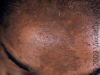 Melasma