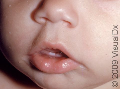 Milia are tiny cysts that occur for unknown reasons in infants.