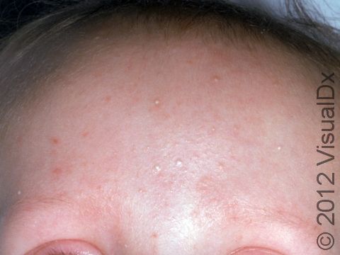 This image displays milia, the small white bumps at the center of the forehead.