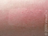 Heat Rash or Prickly Heat (Miliaria Rubra)
