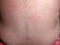 Heat Rash or Prickly Heat (Miliaria Rubra)