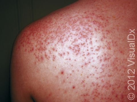 In miliaria rubra, hundreds of red, itchy bumps can suddenly occur, as seen here.