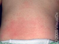 Heat Rash or Prickly Heat (Miliaria Rubra)