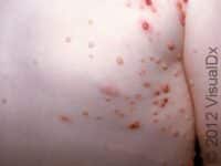 Molluscum Contagiosum (Pediatric)
