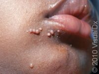 Molluscum Contagiosum (Pediatric)
