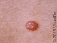 Molluscum Contagiosum