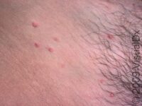 Molluscum Contagiosum