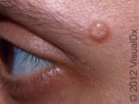 Molluscum Contagiosum