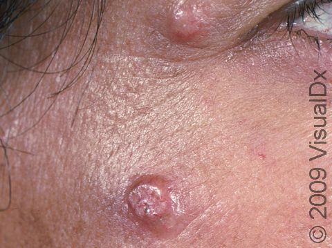 This image displays multiple large molluscum lesions on an immunocompromised patient.