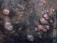 Molluscum Contagiosum