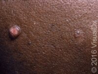 Molluscum Contagiosum