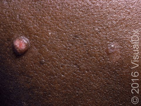 Molluscum contagiosum is a superficial poxvirus infection of the skin with lesions that can vary in size but are typically larger than a dime in diameter.