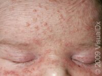 Baby Acne (Neonatal Acne) – Infant