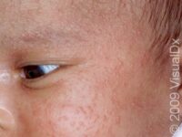 Baby Acne (Neonatal Acne)