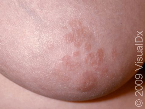 Close-up of scaly, slightly elevated lesions on the areola in nipple dermatitis.