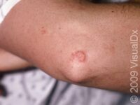 Nummular Dermatitis – Teen