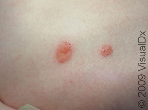 This image displays coin-shaped areas of dermatitis called nummular dermatitis.