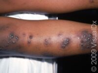 Nummular Dermatitis