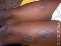 Nummular Dermatitis