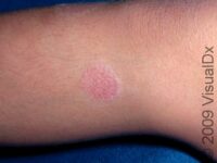 Nummular Dermatitis