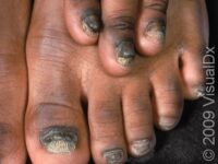 Nail Infection, Fungal (Onychomycosis)