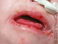 Thrush (Oral Candidiasis)