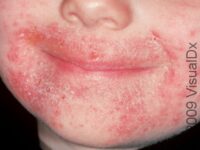 Thrush (Oral Candidiasis)