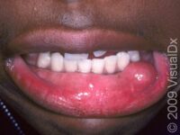Oral Mucocele
