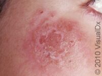 Cold Sores (Orofacial Herpes)