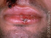 Cold Sores (Orofacial Herpes)