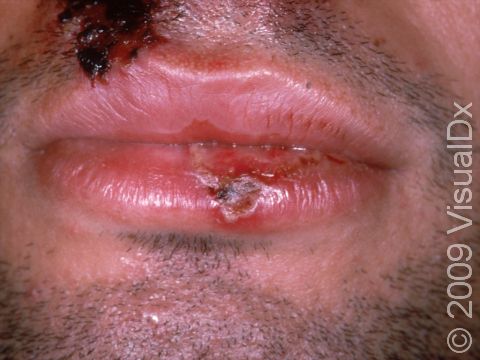 This image displays severe inflammation with skin ulcers and bloody crusts as seen on the right upper lip of this immunocompromised person.