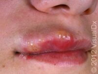 Cold Sores (Orofacial Herpes)