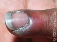 Nail Infection, Bacterial (Paronychia)
