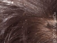 Head Lice (Pediculosis Capitis)