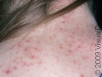 Head Lice (Pediculosis Capitis)