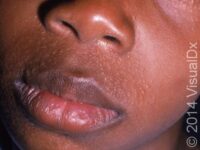 Perioral Dermatitis (Pediatric)
