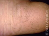 Pitted Keratolysis
