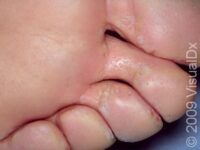 Pitted Keratolysis