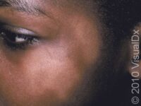 Pityriasis Alba